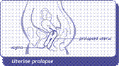 diagram of uterine prolapse