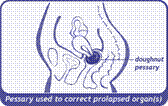 diagram of pessary in place