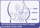 image of Sacrohysteropexy