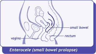 diagram of enterocele