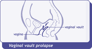 diagram of vaginal vault prolapse